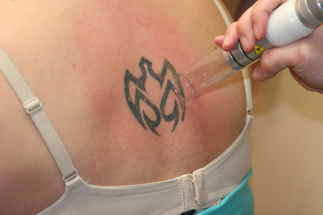 Not all tattoo changes can be fixed with a touch-up, though. Stretch marks 