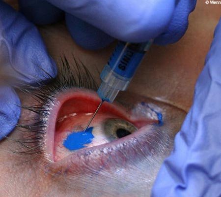 eyeball