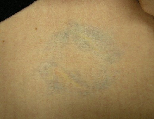 Tags: tattoo removal cream Tags: tattoo removal cream