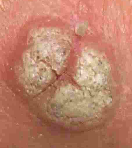 beginning of genital warts. eginning of genital warts.