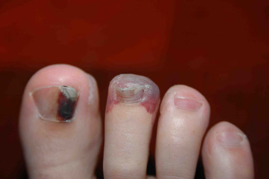 What is a bruised nail?