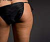 <a href="http://www.fitsugar.com/3607902">Do You Have Cellulite?</a>