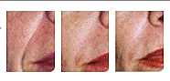 three pictures of a woman's smile lines after ArteFill