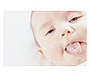Torticollis