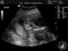This Fetus Looks Like a Duck